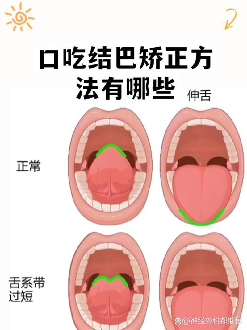 口吃训练班:重拾自信的声音之旅