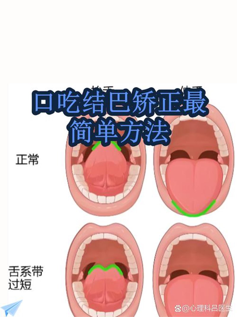 探寻口吃矫正的艺术：一场语言障碍的温柔对话